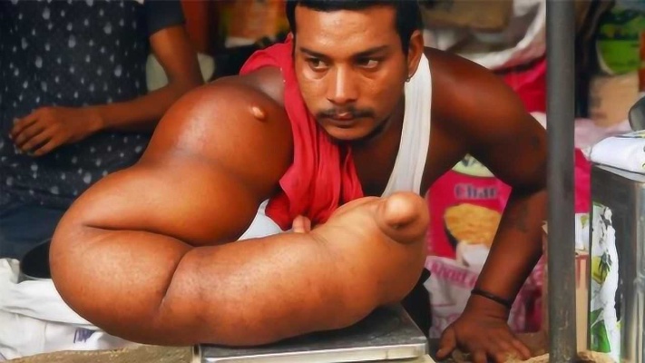 印度男子拥有麒麟臂，一只手臂畸形重40斤，出生时被称为恶魔之子